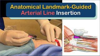 How To Succeed At Arterial Line Insertion Anatomical Landmark-Guided