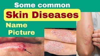 Skin diseases name and picture  skin diseases picture with name  skin problem