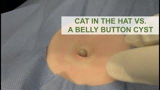 Cat in the Hat vs. A Belly Button Cyst  Dr. Derm