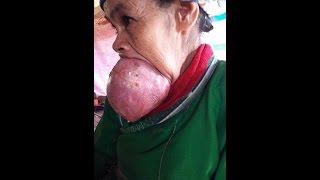 GIANT Woman with huge tongue awaits an operation in North Vietnam