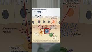 Pathogenese der Zöliakie