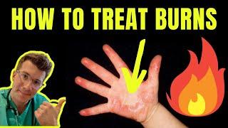 HOW TO TREAT AND MANAGE BURNS AND SCALDS  DOCTOR EXPLAINS plus first aid tips