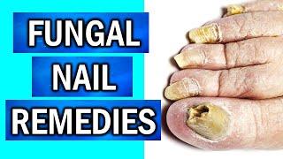 8 EFFECTIVE Home Remedies to Cure Fungal Nail Infections