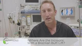 Where Are the Incisions with the Brazilian Butt Lift?