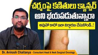 క్యాన్సర్ కణితిని గుర్తించండి ఇలా  How to Identify Cancer Tumor in Telugu  Kaizen Oncology Network