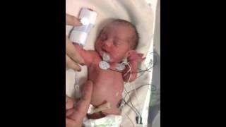 32 week preemie baby on day 2