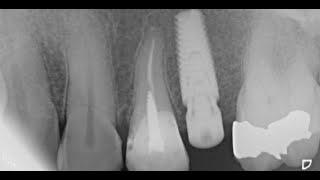 Placing MIS C1 XD 4.20x11.50mm Implant in Maxilla Jaw #25