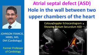 Atrial septal defect ASD Hole in the wall between two upper chambers of the heart