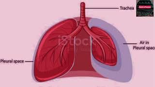 CHEST TRAUMA ?