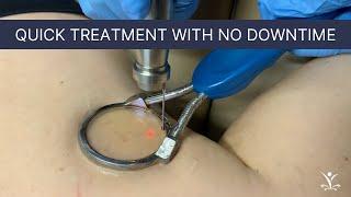 Laser Treatment for Spider Veins on Legs