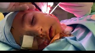 BABY SITTER SURGERY IN FACIAL PARALYSIS   XII-VII NERVE TRANSFER 