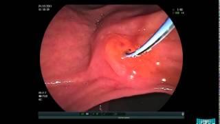 Choledocholithiasis - Sphincterotomy and Stone Extraction with a Basket