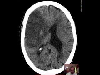 CT Head Anatomy w MCA Hem Stroke  DISCUSSION by Radiologist