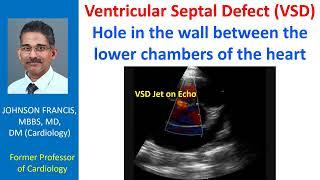 Ventricular Septal Defect VSD - hole in the wall between the lower chambers of the heart