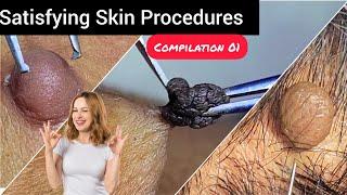 Care to skin and Relax to mind Satisfying skin tag removal compilation 01 @Dr.AMAZINGSKIN