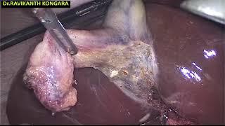 GALL BLADDER  PROCEDURE BY DR RAVIKANTH KONGARA