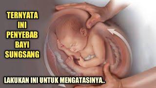 Hal yang Bisa Menyebabkan Bayi Sungsang dan Cara Mengatasinya