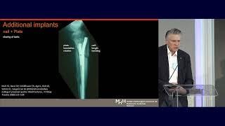 10  Tibial Fractures   How to Ensure Reduction   Christian Krettek MD mp4
