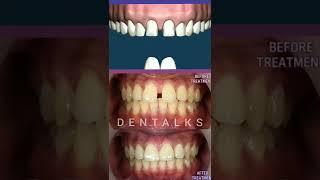 #veneers Worried about Gap between Front Tooth ?? Dental Veneers  Patient Education Animation