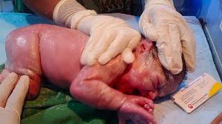 New born baby passed meconium during birth meconium mixed with vernix clean it with baby oil