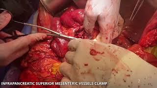 Asvide Total pancreatectomy with complex vascular resection.