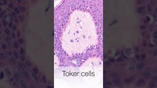 Toker Cells #pathologylecture #biology #generalpathology #breastcancer #pathologyshorts