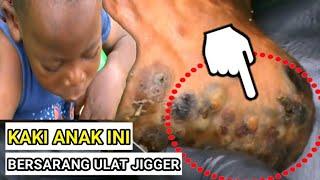 MENGERIKAN ULAT JIGGER BERSARANG DI KAKI ANAK AFRIKA.