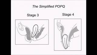 IUGA simplified POP-QPOP