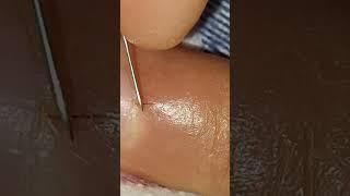 Batık kılların Temizliği- İgrown hair removal