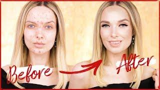 KENDALL JENNER ACNE COVERAGE MAKEUP TUTORIAL  MyPaleSkin