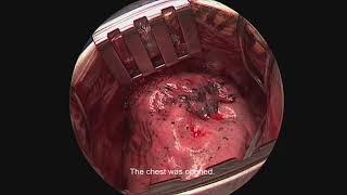 Asvide A less invasive lateral thoracotomy approach for the resection of the anterior apical...