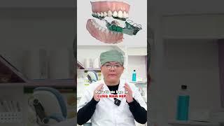 Hàm Nong Nhanh #niengrang #nhakhoaseadental #invisalign