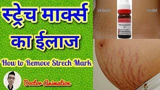 स्ट्रेच मार्क्स का बेस्ट होमियोपैथिक ईलाज   Best Homeopathic Treatment for Strechmark in hindi