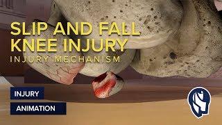 Slip and Fall Knee Injury Mechanism Animation
