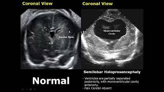 Fetal Brain Ultrasound Normal Vs Abnormal Image Appearances Comparison  Fetal Brain Pathologies USG
