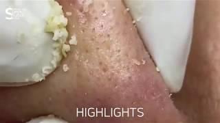 Highlights 하이라이트 ACNE TREATMENTS 여드름 피지 블랙헤드 제거