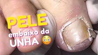 Ela achou quer era um pequeno pedaço de unha - Veja o tamanho da pele que tinha em baixo da unha