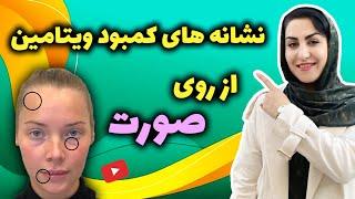 کمبود ویتامین های بدنت رو از روی صورتت بدون آزمایش تشخیص بده و درمان کن