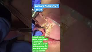 Wisdom Tooth Flap Design How To Remove Wisdom Tooth