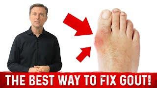 GOUT ARTHRITIS What Causes Gout and What Foods to Avoid for Gout