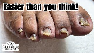 How to Trim Toenails with Nail Fungus #nails #satisfying