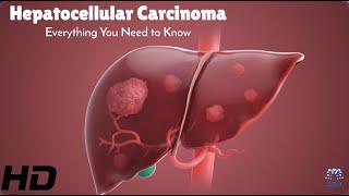 Fighting Hepatocellular Carcinoma Key Facts