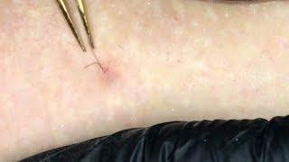 Ingrown Hair Removal