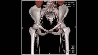 Femoral Artery Pseudoaneurysm with Bleed