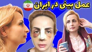 اومدم ایران دماغمو عمل کردم ولاگ عمل بینی Rhinoplasty in Iran