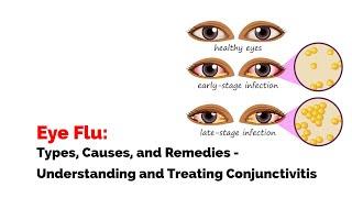 Eye Flu Types Causes and Remedies - Understanding and Treating Conjunctivitis.