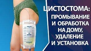 Цистостома замена и промывание цистостомы на дому и в клинике установка и удаление цистостомы