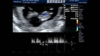 11-14 hafta erken ayrıntılı ultrason