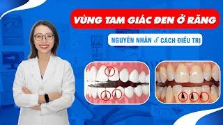 Vùng Tam Giác Đen Ở Răng Và Nguyên Nhân & Cách Điều Trị  Nam Bùi Vinalign