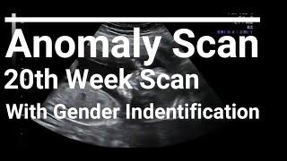 anomaly scan 20 week scan How to identify gender